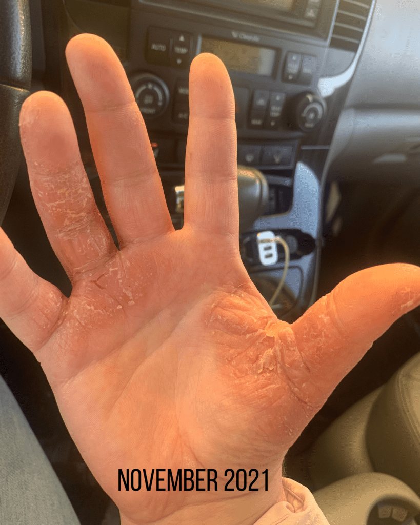 photo of hand with the beginning of palmoplantar pustular psoriasis 