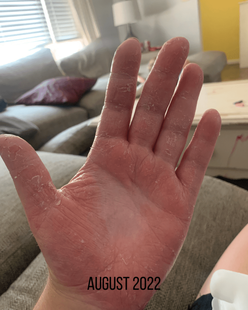 Photo of palmoplantar pustular psoriasis with some healing. Hand still appears very red with some cracking and flaking, there is a small area of white skin in the center of the palm